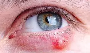 انواع بیماری پلک چشم